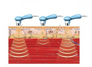 Ультразвуковая терапия лица и тела в коррекции инволюционных изменений кожи